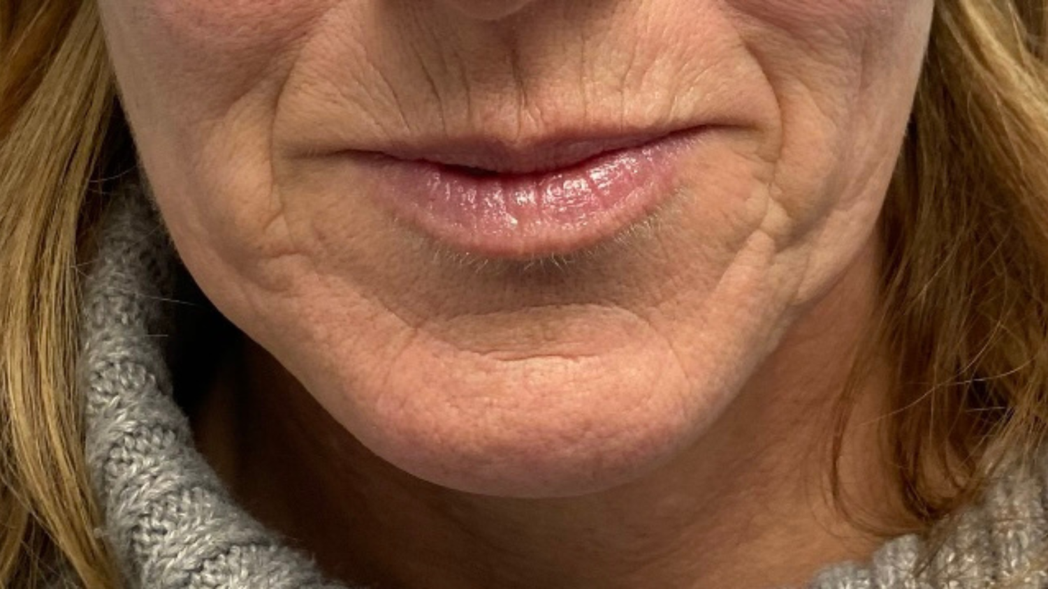 Can Fractional Radio Frequency Microneedling Treat Lip Lines and Laughter Lines?