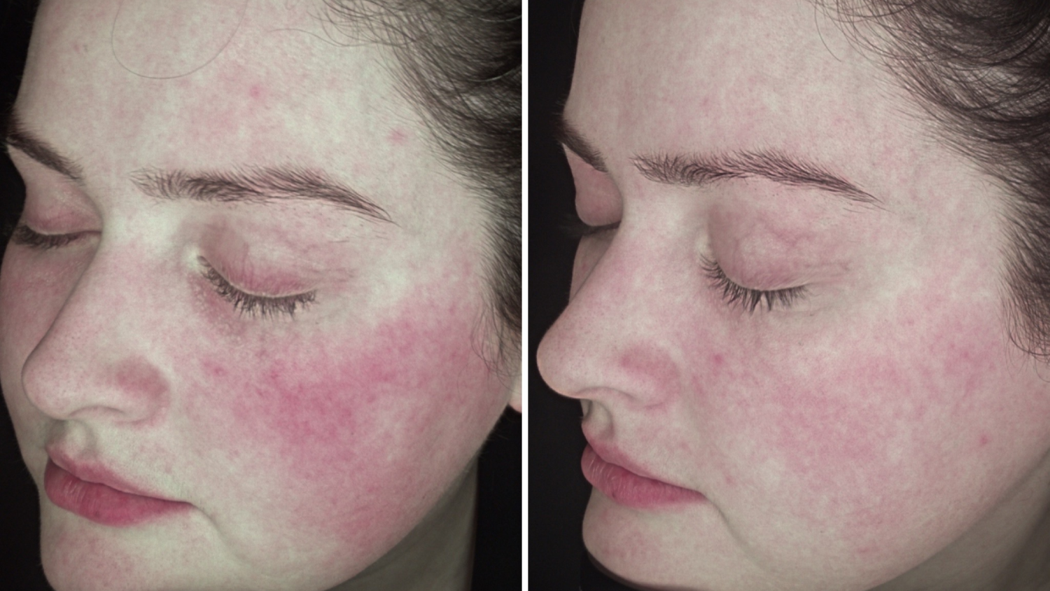 What is Rosacea and Acne Rosacea?