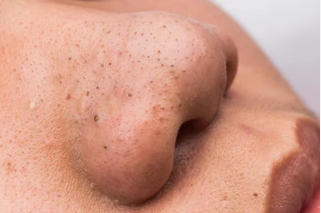 What are Blackheads and Milia?