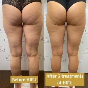 Results from HIFU body treatment
