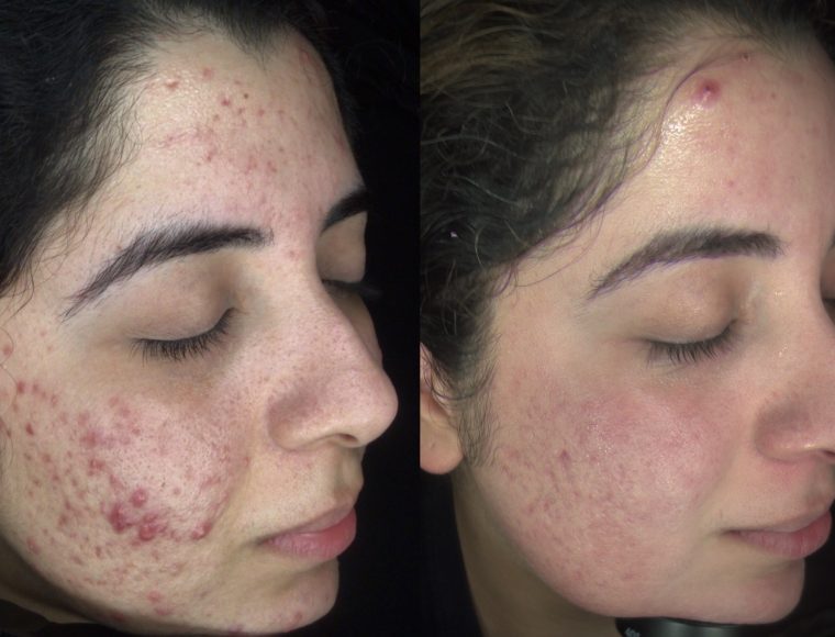 Skin Treatment Before and after images