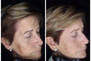 IPL Pigmentation before and after