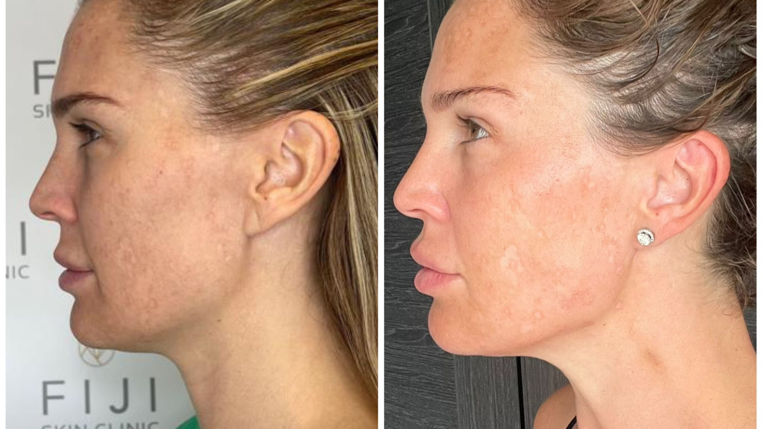 Danielle Lloyd’s Morpheus8 Treatment – Before & After