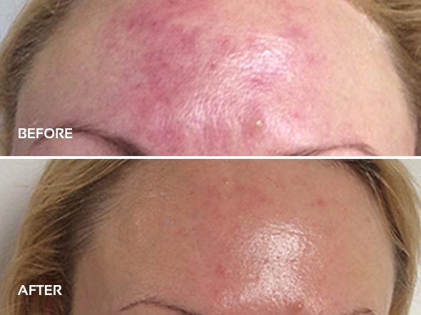 Dermalux Light Therapy before vs after image of forehead