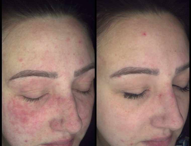 Skin analysis images before and after treatment