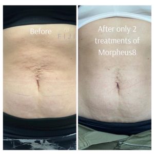 Before and after Morpheus8 treatment for saggy belly