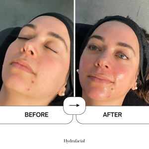 Hydrafacial treatment before and after images