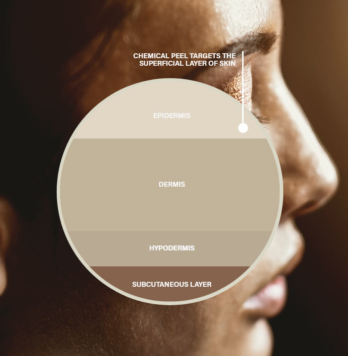 Chemical Peel Diagram