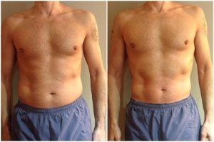 Lipofirm stomach before and after