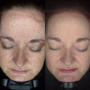 Skin Rejuvnation on mature skin using laser