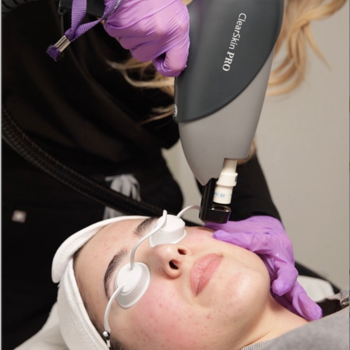 acne treatment with laser