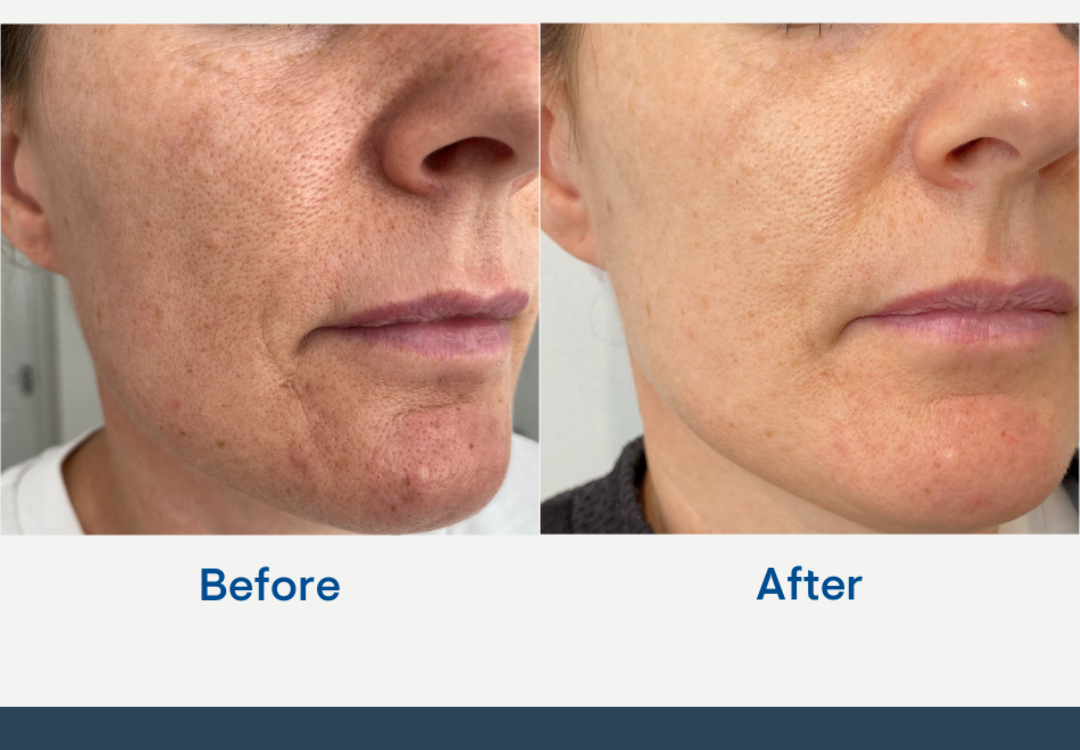 Radiofrequency Microneedling / RF microneedling before after