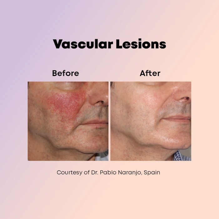 alma harmony clearvas treatment for vascular lesions